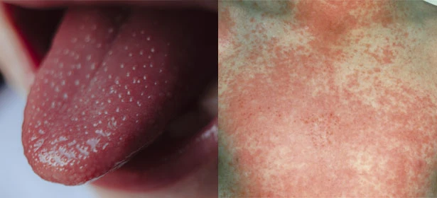 Examples of strawberry tongue